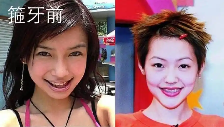 原来这些明星曾经都龅牙绑完牙后完全两个人简直是整容级的成功啊