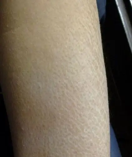 摆脱冬季皮肤干燥起皮苦恼,婵皙还你嫩滑肌肤!