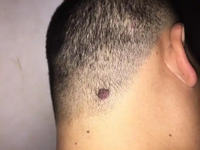 头上长了个肉疙瘩头上长了一个肉疙瘩,这是什么东西,怎么治疗,如图