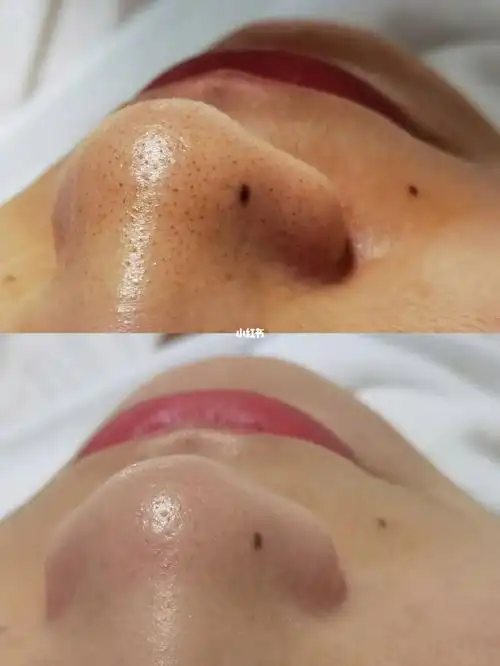 毛孔深层清洁对比图