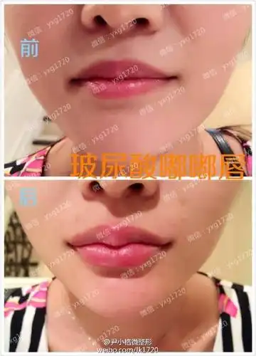 玻尿酸嘟嘟唇前后对比