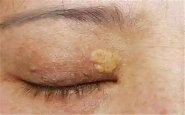 这种情况是眼睑黄瘤,多出现在脂肪代谢异常或明显障碍的中老年人身上