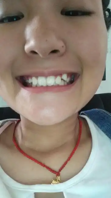 2016-07-11  问医生 浏览官网  展开全部 也算是虎牙的,是可以做牙