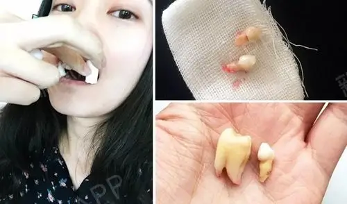 一直被两颗长歪的虎牙困扰,2016年走进医院,拔掉_圈子-新氧美容整形