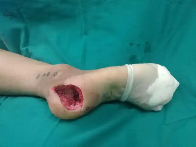 足跟部清创后皮肤/骨缺损修复
