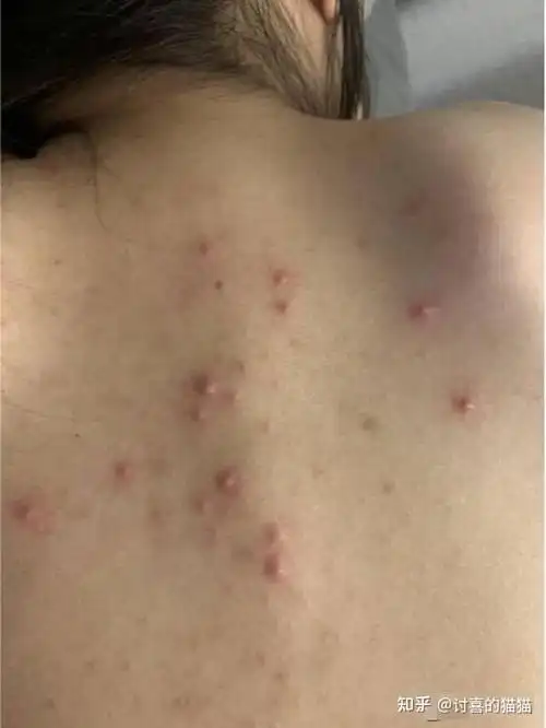 背上长痘怎么办终于找到了背后痘痘克星