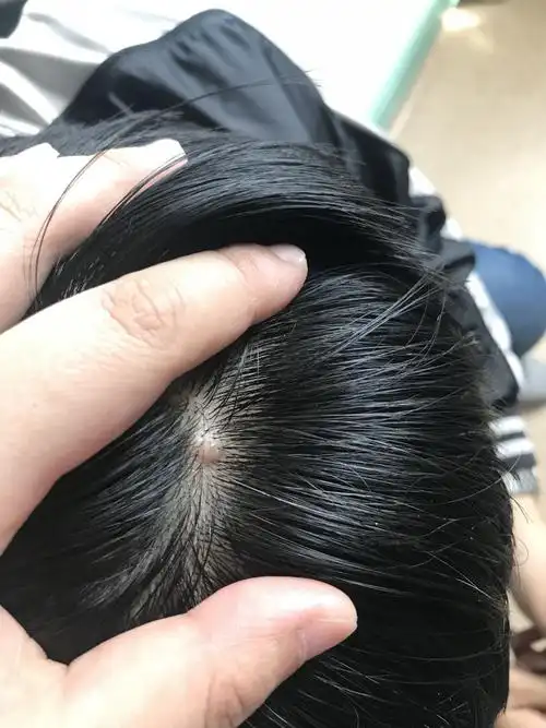 头上了长一个透明的小包,不疼不痒,好多年了,包里还有头发