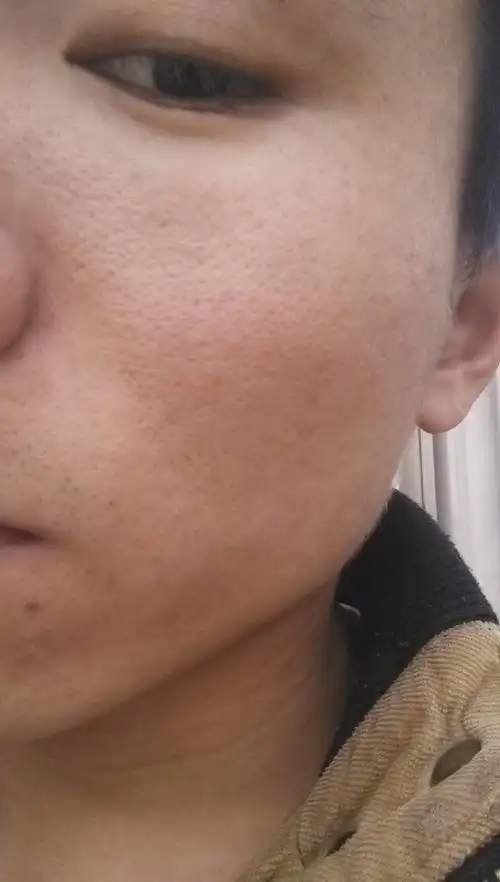 我脸上毛孔粗大,很多粉刺,要买哪类洗面奶类的好,平时要注意什么