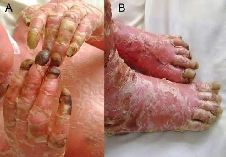 a severe case of erythrodermic psoriasis associated