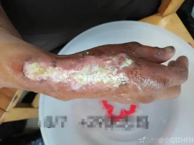 糖尿病日光性皮炎