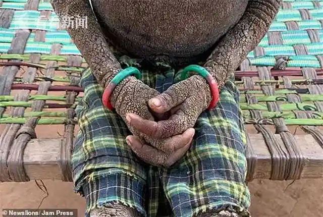 7岁女孩全身长"鱼鳞"犹如被石化 走路坐下都困难