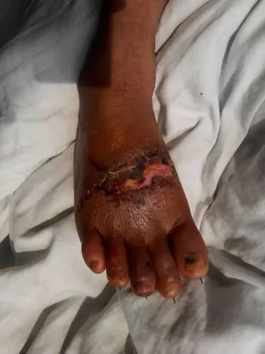 请问在工地干活把脚趾算切断了,现在接上去了,工地答应给五万了事,不