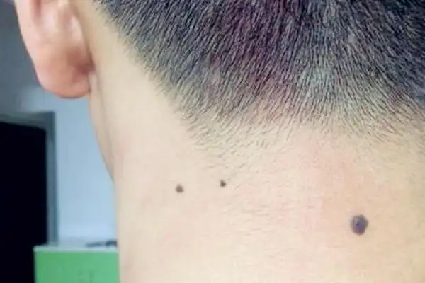 男人耳朵上长痣好吗