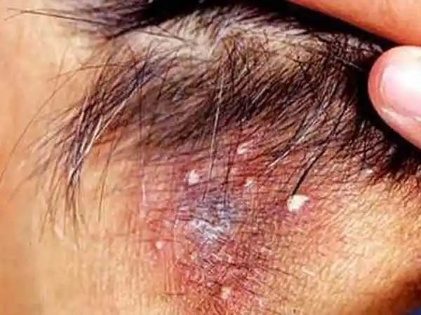 毛囊炎怎样护理比较好