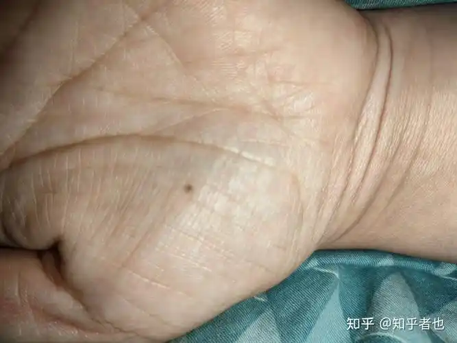 左手大鱼际有颗痣? - 知乎