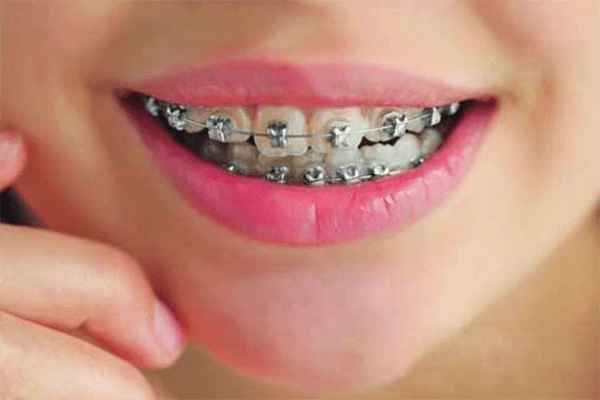 合肥哪家做儿童牙齿矫正好?