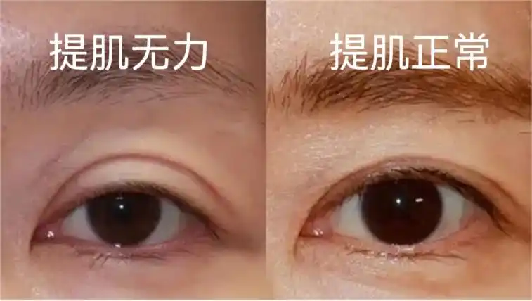 双眼皮提肌不要乱做!医生教你2招判断是不是提肌无力!