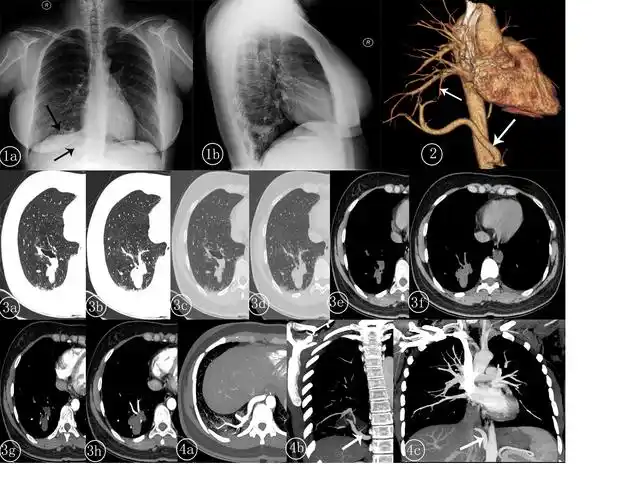 右肺下叶肺隔离症一例-中国期刊网
