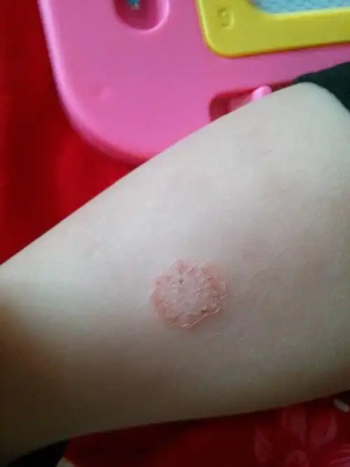 请懂皮肤病的人看看我女儿腿上长得是金钱癣吗?谢谢了!