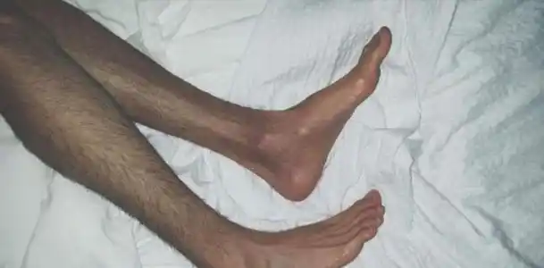 为何有的男性腿毛旺盛有的却很光滑腿毛少意味着什么