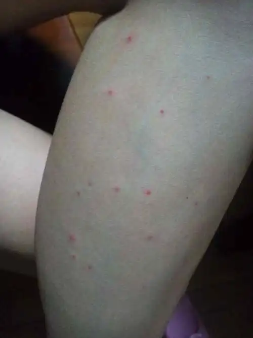 皮肤上有好多小红点,不疼不痒不肿