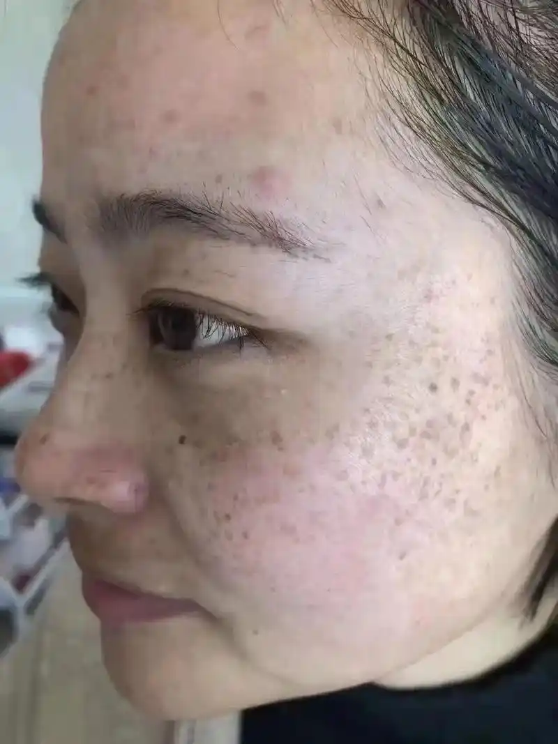 雀斑是发生在面部皮肤上黄褐色点状色素沉着斑,9 - 抖音