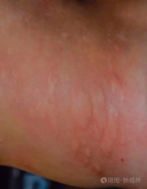 背部和两侧皮肤过敏皮肤上的过敏反应表现为肿胀和发红