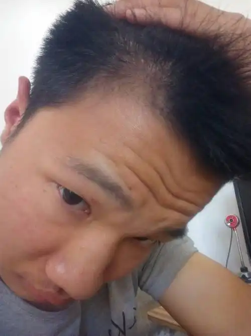 额头两侧头发脱发,毛囊萎缩,头发细软,张不长,用米诺可以吗?