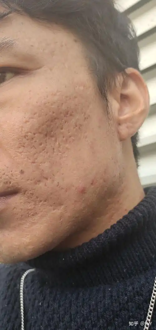 十二年痘坑现在准备试一试