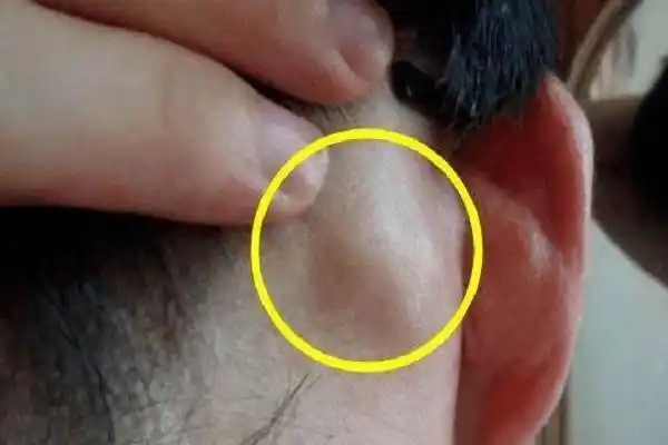 22岁小伙患上恶性淋巴瘤注意身体莫名出现的这些症状可能是淋巴癌征兆