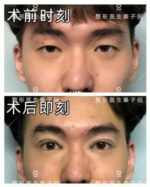 帅哥双眼皮与开眼角即刻对比_帅哥_开眼角_双眼皮_美妆_医美整形