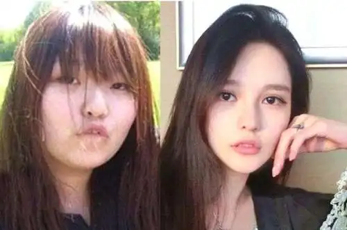 周扬青整容前后对比
