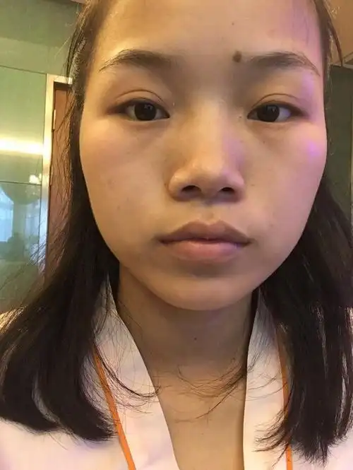 我之前的鼻子真的是很扁平,鼻头也有点大,看上去一点_圈子-新氧美容