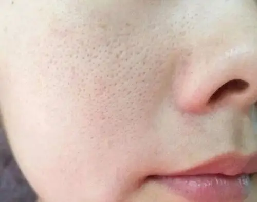 皮肤粗糙怎么办?