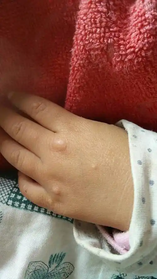 一岁半小孩身上看开始身上像是蚊虫叮咬起的红疙瘩,抹药打针也不起