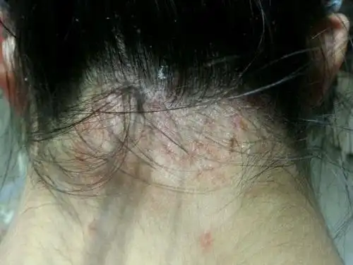 过敏性皮炎都有哪些预防方法