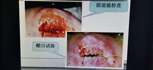 妇科小知识:同房后出血是哪里出问题了