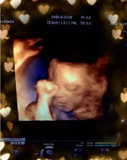 现已怀有8个多月身孕的霍思燕,与8月19日通过微博晒腹中胎儿b超照,并