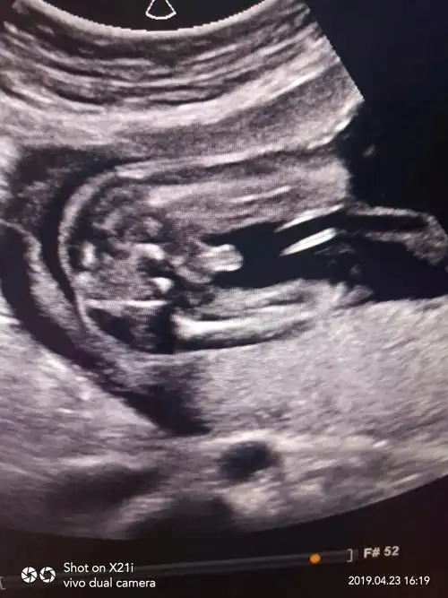 来来来,猜男女啦,生殖器附图