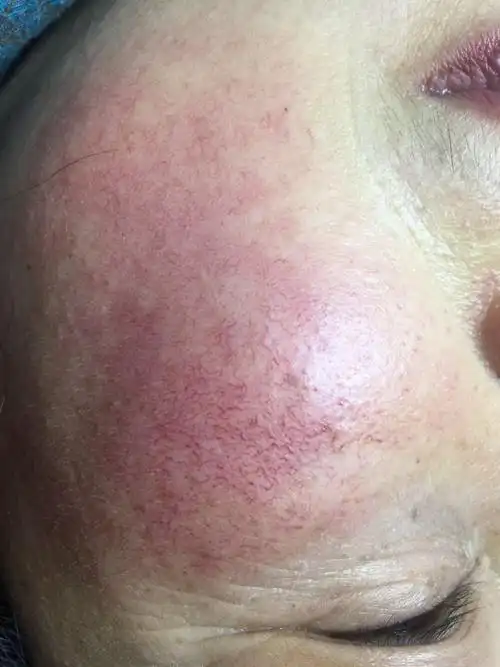 角质层太薄,肌肤过于敏感,毛细血管扩张是红血丝的罪魁祸首!