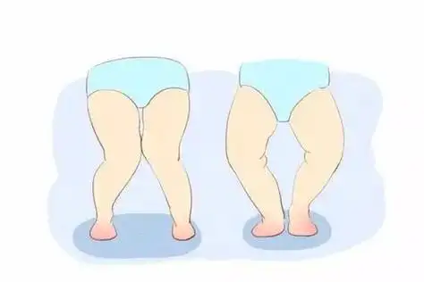 宝宝走路内八字怎么回事宝宝走路内八字怎么矫正