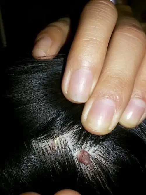 15年前头皮长的,好像长大了一点点,不疼