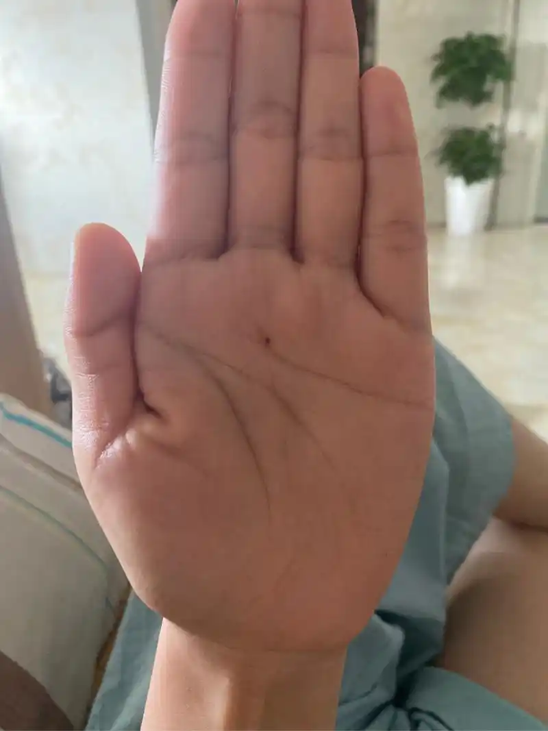 2023年下半年左手长一颗很小痣随时时间越长越大有谁懂嘛!有啥说法嘛.
