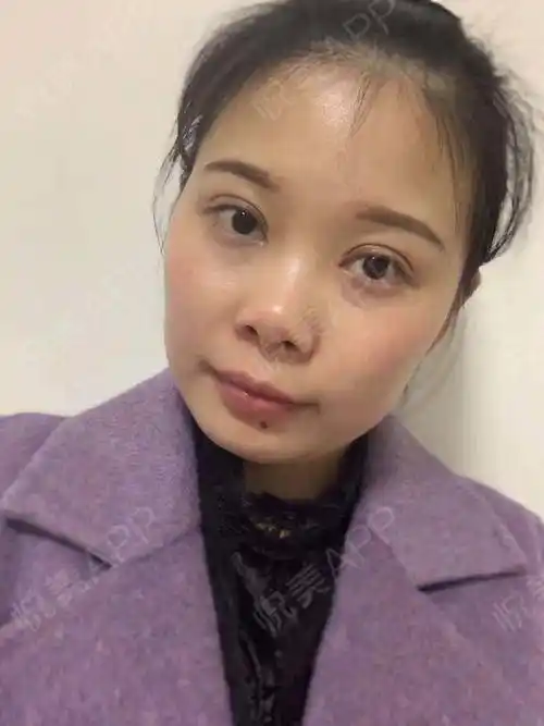 全切双眼皮_眼部多项_双眼皮_眼部整形_子木皆非分享图片9