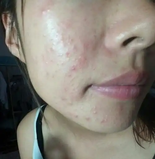 脸部皮肤过敏,红肿,有痘痘还痒.该怎么治疗?