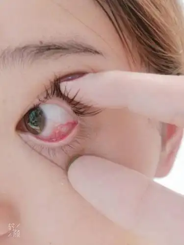 早上起床看见自己眼睛里边有大块红血丝,帮忙看看怎么回事