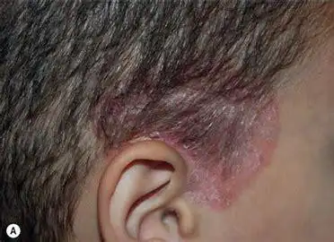 积医科普皮肤科专家教您如何对付头皮脂溢性皮炎