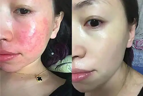 季节性脸过敏怎么办换季脸过敏发红怎么办