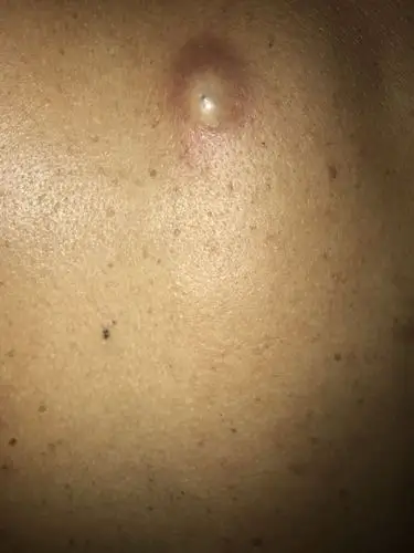 我爸背上长了个包,好多年了,以前都是红色,肉色,现在有点发白,而且在