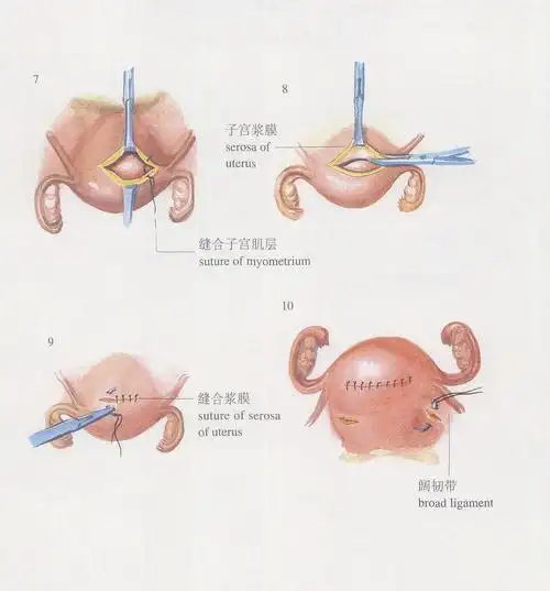 2.因肌瘤而致不孕或流产者.【术前准备】同"子宫切除术".